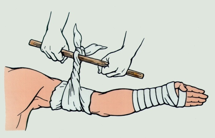 Безпечне бинтування з застосуванням тиску можливе в наступних зонах